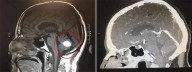 Milagre: Tumor cerebral de padre desaparece logo antes de ele ser operado 