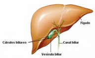 Como fazer a limpeza gradual de pedras na vesícula biliar e evitar a sua remoção cirúrgica